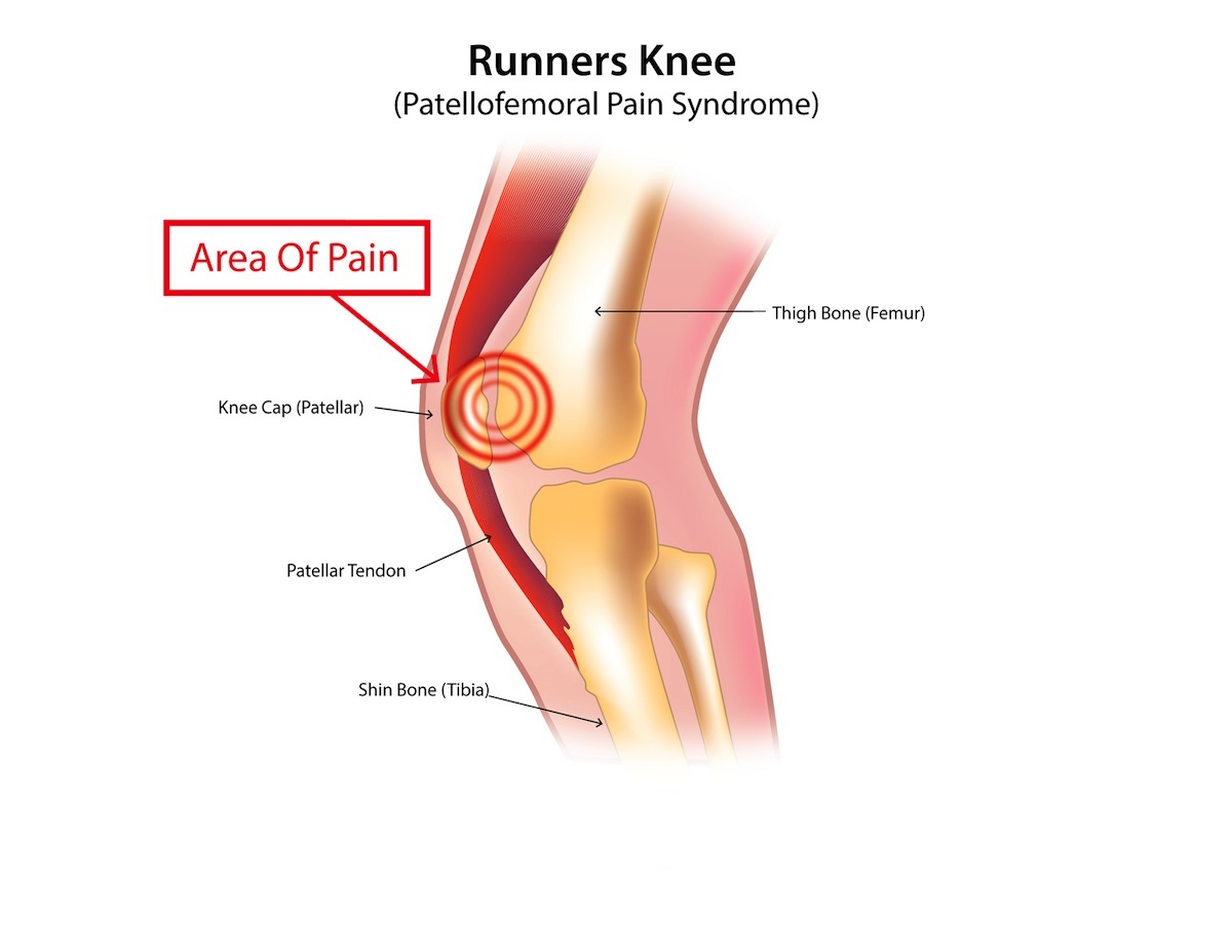 runners-knee